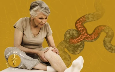 أسباب دوالي الساقين عند النساء والتوقيت المناسب لعلاجها
