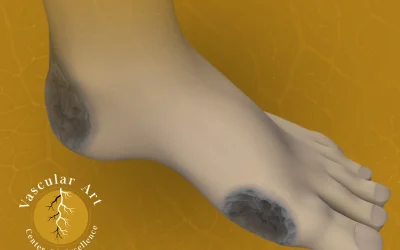 علاج القدم السكري