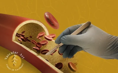 متى ينبغي إجراء جراحة اوعية دموية لعلاج تصلب الشرايين