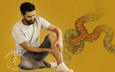 ما سبب ظهور دوالي الساقين عند الرجال؟